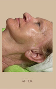 After Image: DMK Enzyme Therapy