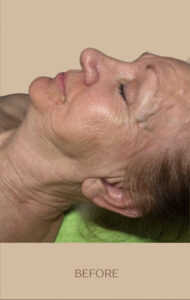 Before Image: DMK Enzyme Therapy