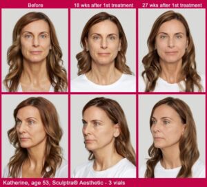 Sculptra before and afters